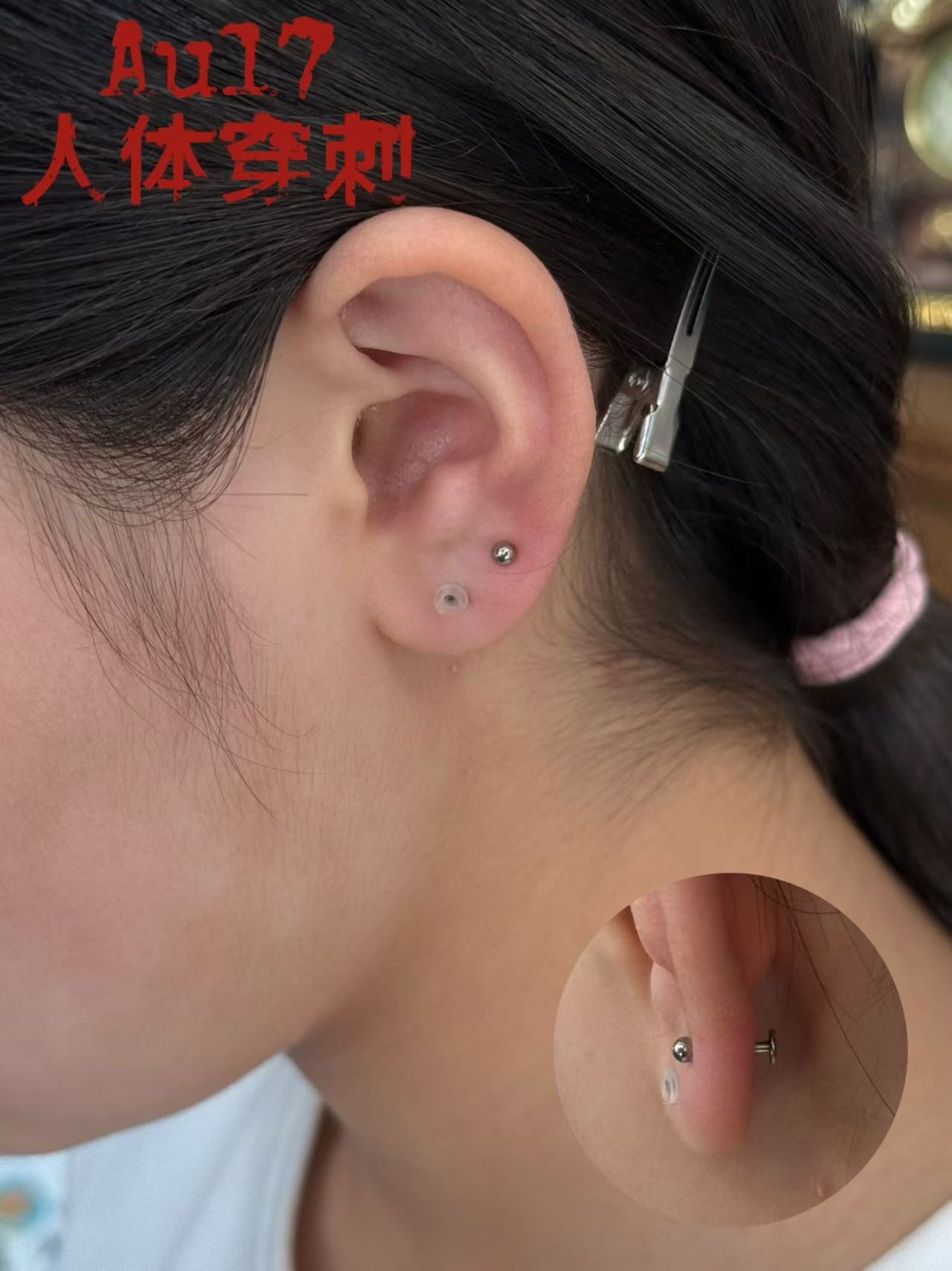 高位耳垂